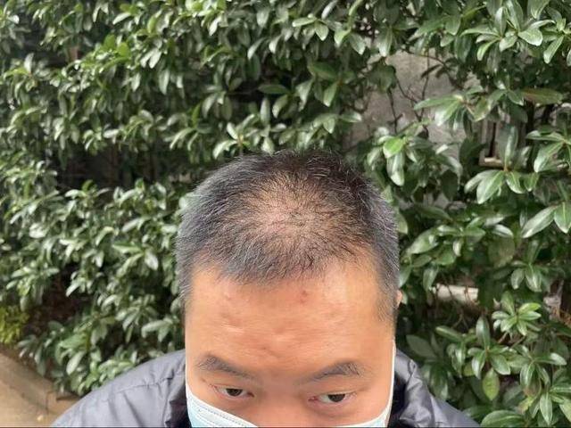 “还能反光<strong></p>
<p>东证券</strong>！”长沙男子植发近9月称后脑勺“像狗啃过”
