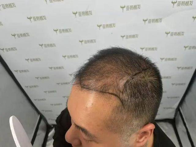 “还能反光<strong></p>
<p>东证券</strong>！”长沙男子植发近9月称后脑勺“像狗啃过”